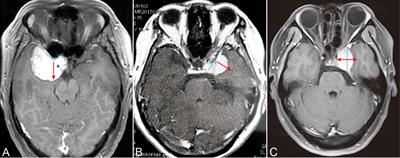 Individualized Cerebral Artery Protection Strategies for the Surgical Treatment of Parasellar Meningiomas on the Basis of Preoperative Imaging